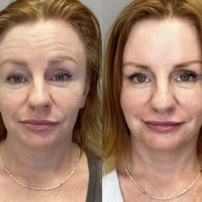 Before and after facial rejuvenation treatment comparison.